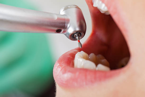 Best Emergency Dental Extractions in Waelder, TX